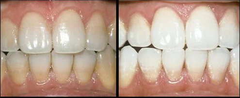 teeth with and without whitening treatment
